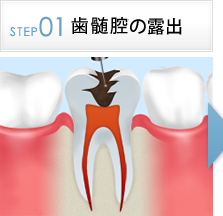 STEP1根管の露出