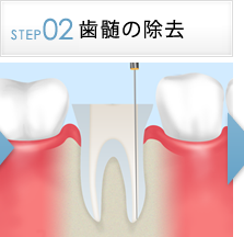 STEP2歯髄の除去