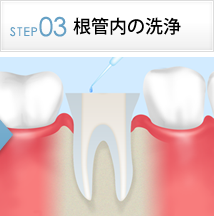 STEP3根管内の洗浄