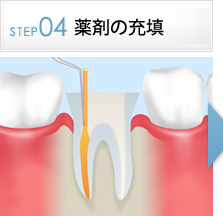 STEP4根管内の無菌化