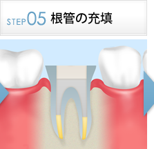 STEP5薬剤の充填