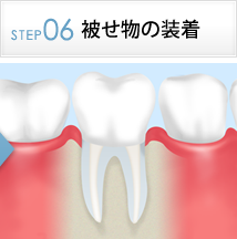 STEP6被せ物の装着