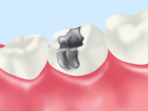 銀歯（金銀パラジウム合金）
